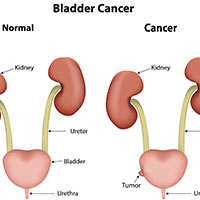 Urinary Bladder Cancer: Causes, Symptoms And Treatment