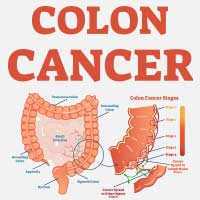 Colon Cancer: Causes, Symptoms And Treatment