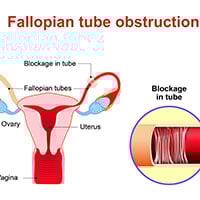 Fallopian Tube Cancer: Causes, Symptoms And Treatment