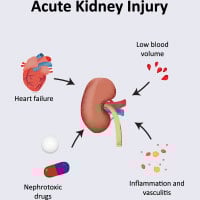 Acute Kidney Failure: Causes, Symptoms And Treatment