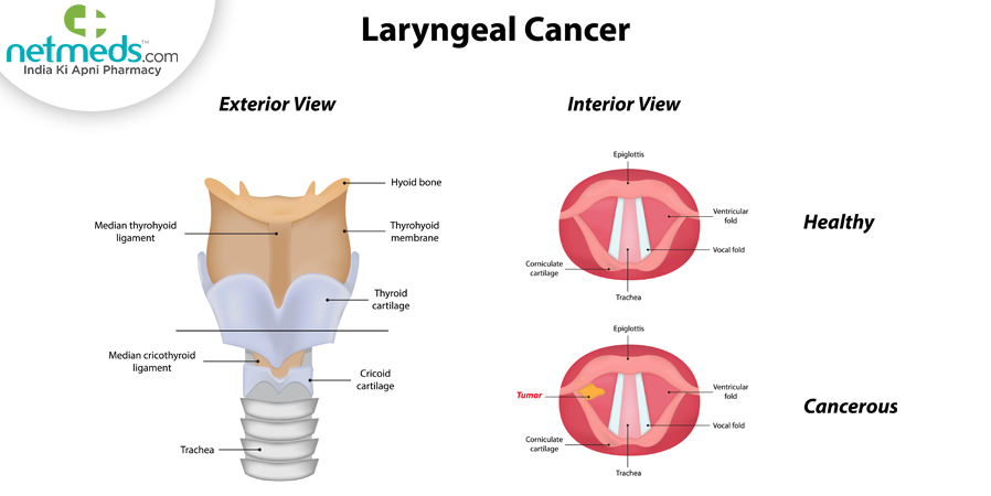 Laryngeal Cancer