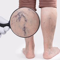 Ayurveda For Varicose Veins: Fantastic Herbal Remedies To Heal Swollen Legs And Blood Clots