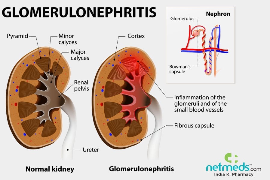 glomerulonephritis