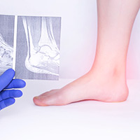 Reactive Arthritis: Causes, Symptoms and Treatment