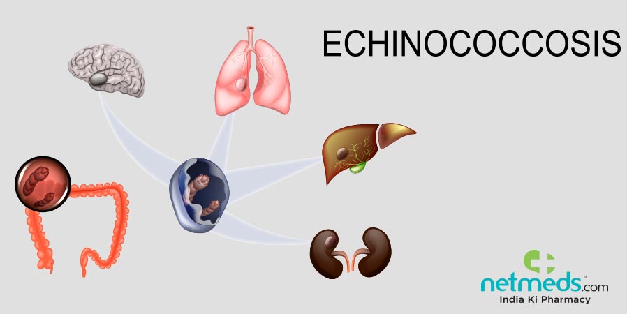 Echinococcosis