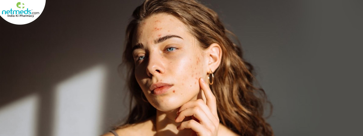 stress-induced-skin-big_1200x450