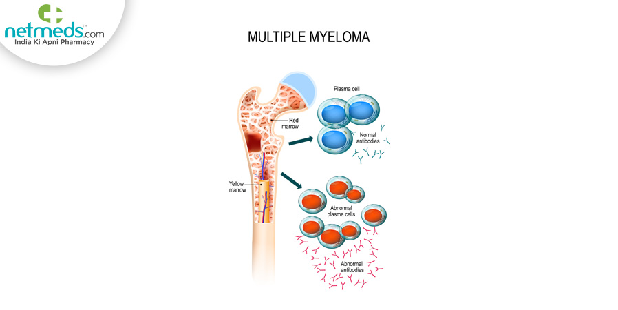 Multiple myeloma