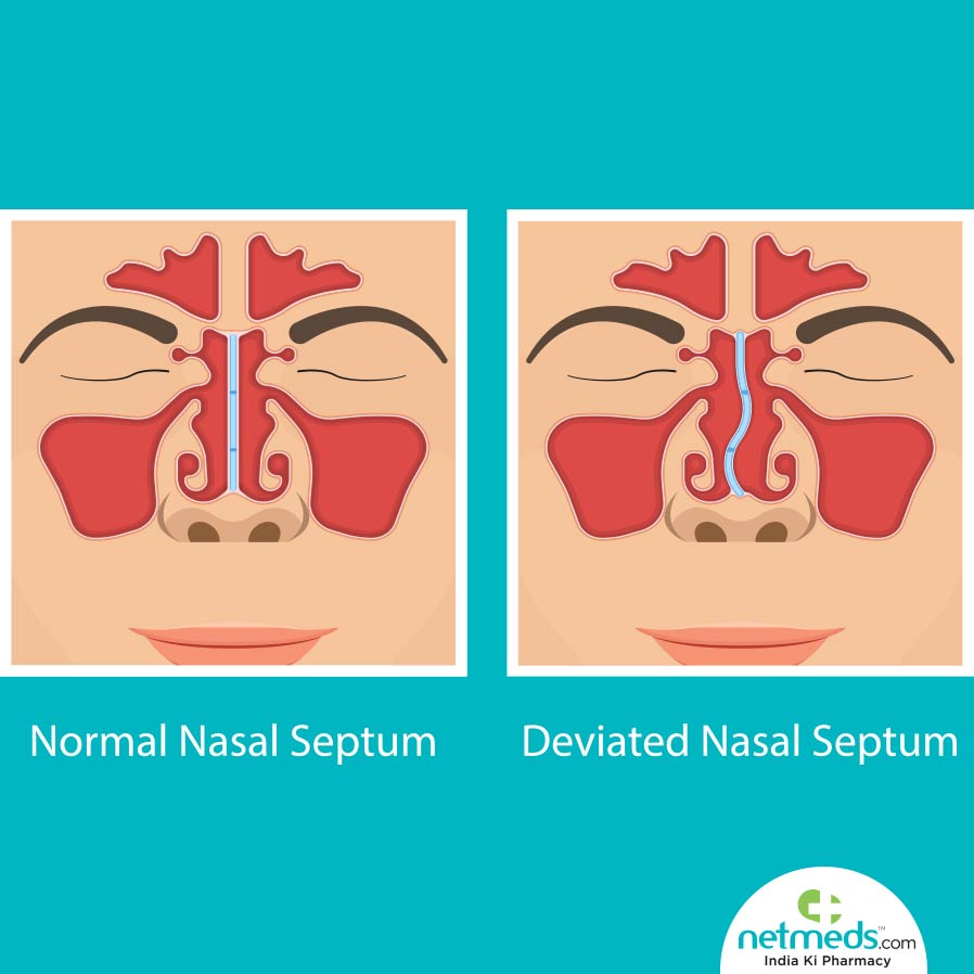 Comparison of Normal and Deviation Nasal