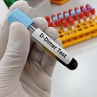 D-dimer Test: What Is It And What To Expect?