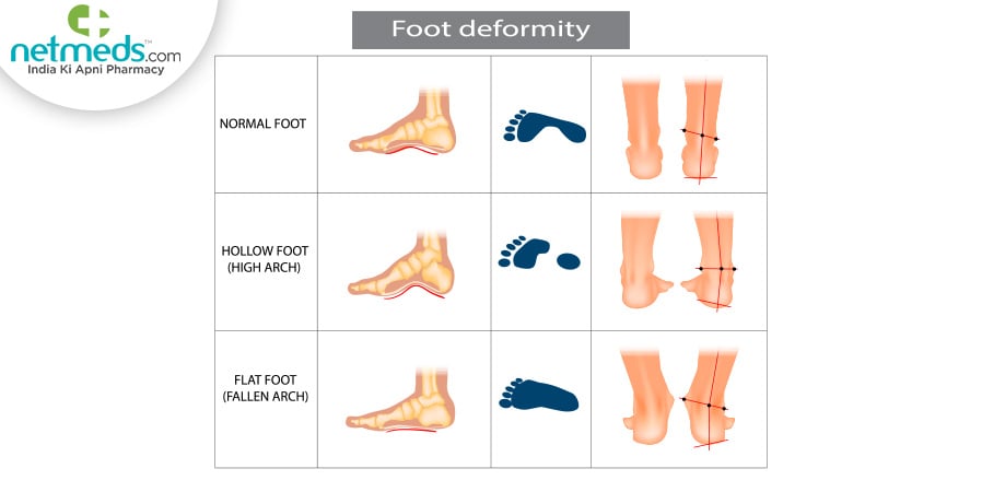 Foot deformity