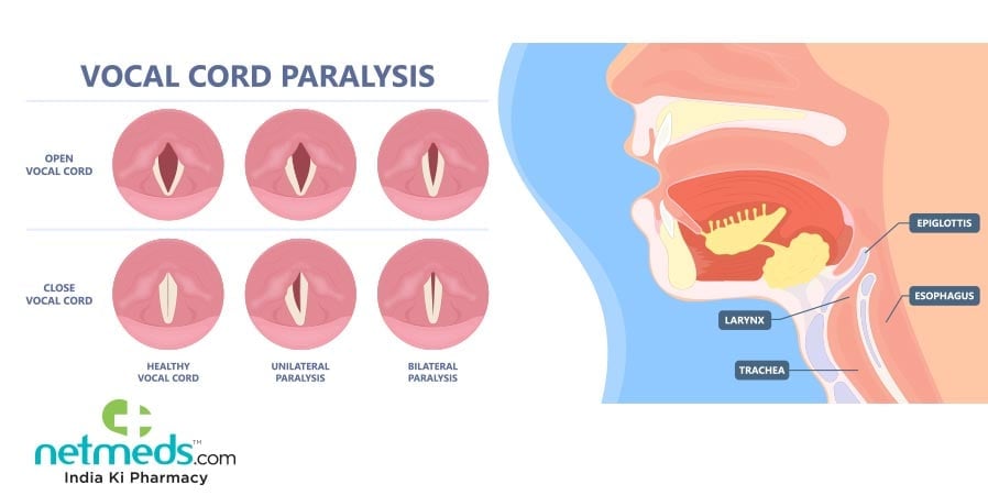 Vocal Cord Paralysis