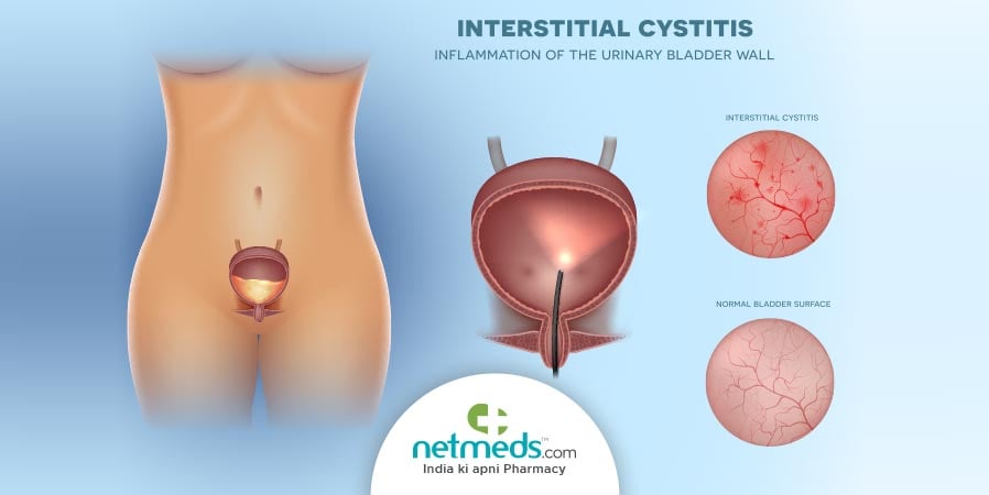 Interstitial cystitis