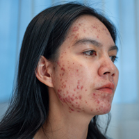 Cystic Acne: Identification, Types, Causes, Proven Herbal Remedies, Prevention