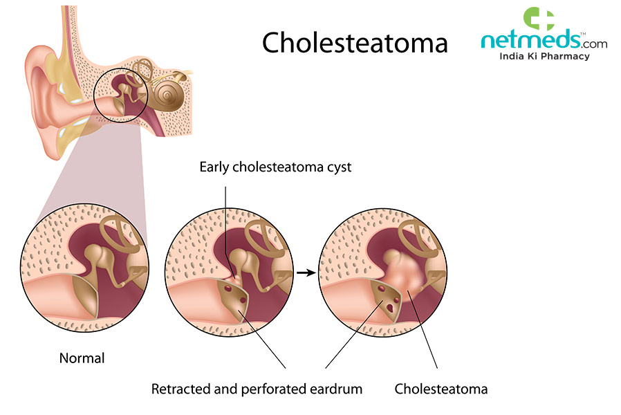 cholesteatoma