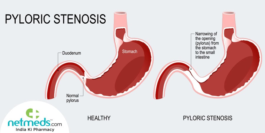 Pyloric stenosis