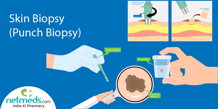 Skin Biopsy (Punch Biopsy)