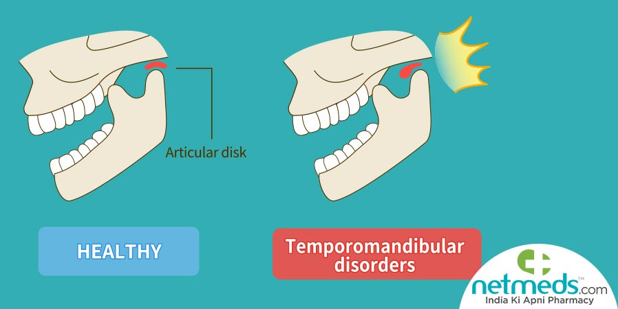 Temporomandibular joint disorders