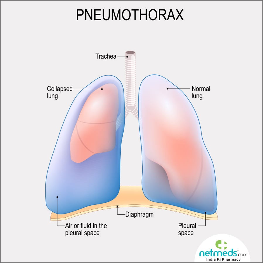 pneumothorax
