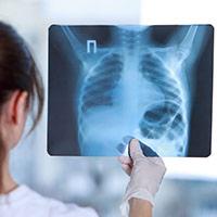 Chest CT Scan For COVID-19: Know Who Should Get It And The Key Facts