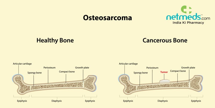 Osteosarcoma