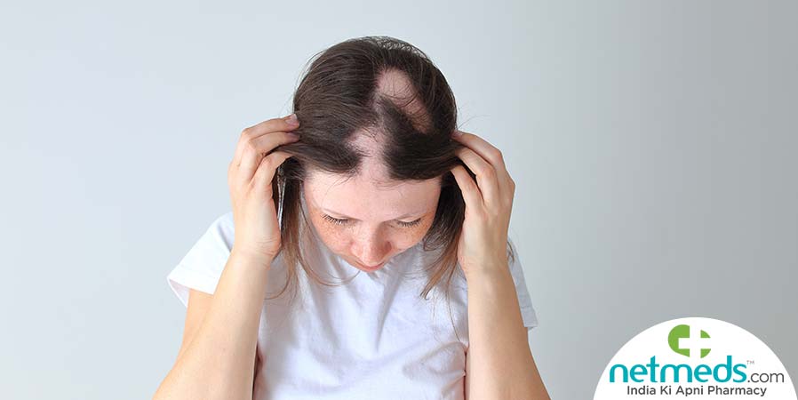 Woman with Alopecia Areata