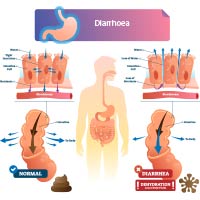 Diarrhoea: Causes, Symptoms and Treatment