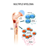 Multiple Myeloma: Causes, Symptoms And Treatment