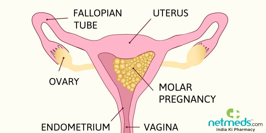 Molar pregnancy diagram