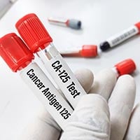 CA -125 Test: Purpose, Procedure, And Results
