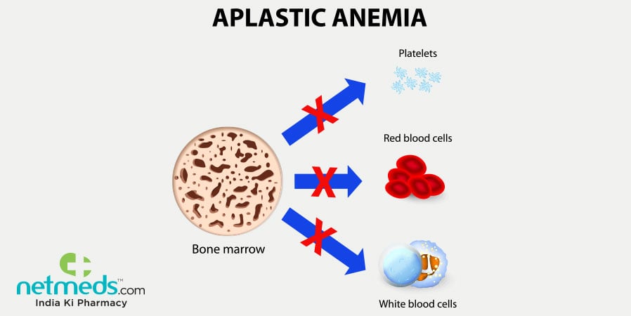 aplastic anaemia