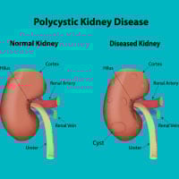 Polycystic kidney disease: Causes, Symptoms And Treatment