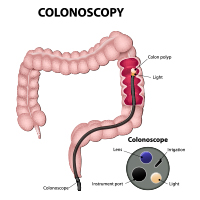 Colonoscopy: Procedure, Risks And Results