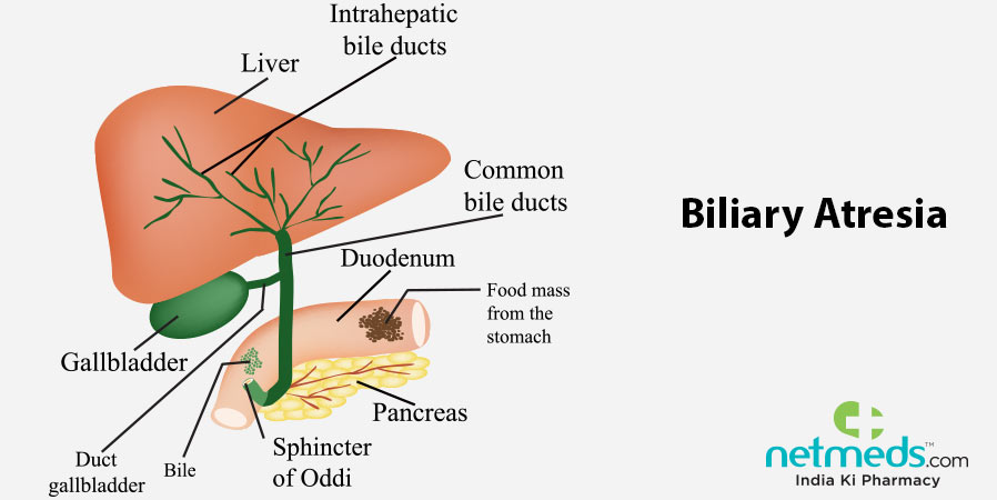 Biliary astresia
