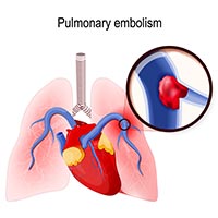 Pulmonary Embolism: Know The Causes, Symptoms And Treatment Of Blood Clot In The Lungs