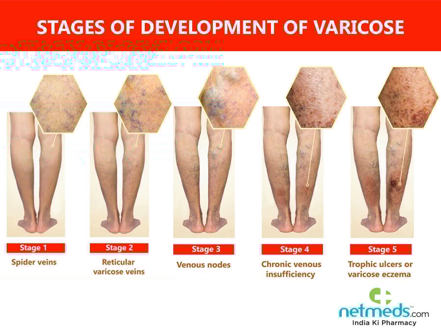 varicose eczema