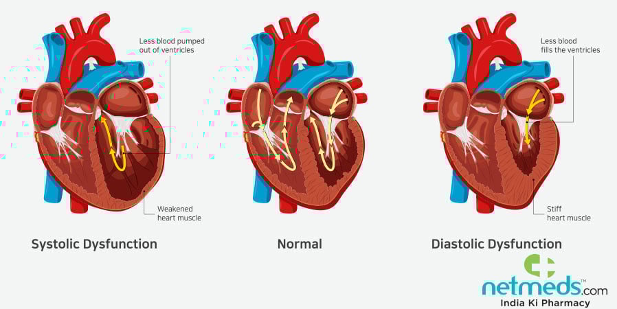 Heart failure