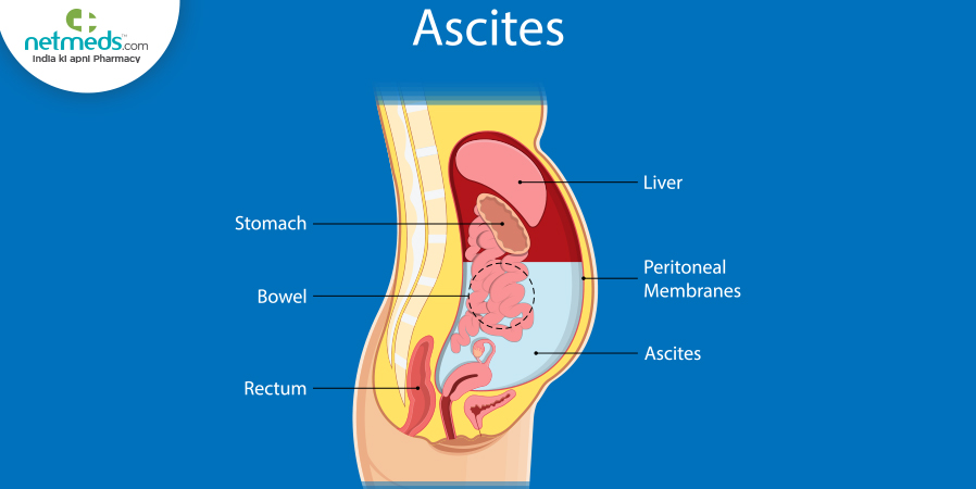 Ascites