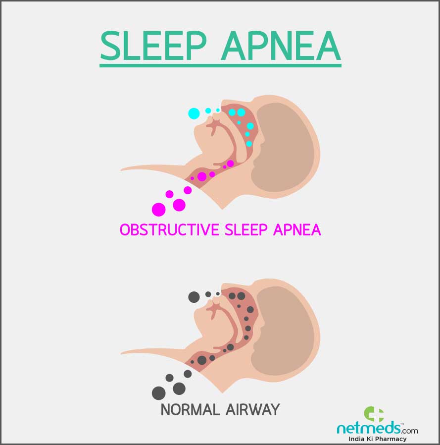 sleep apnea