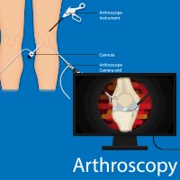 Arthroscopy: Procedure, Risks And Results