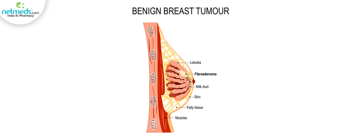 fibroadenoma