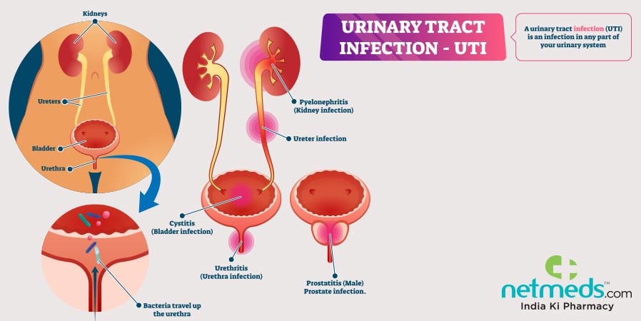 Urinary Tract Infection - UTI
