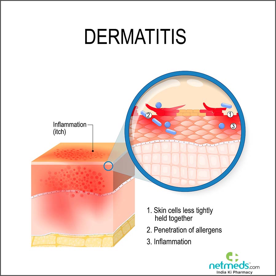 Contact dermatitis causes
