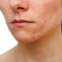 Symptom that will help to identify Lupus