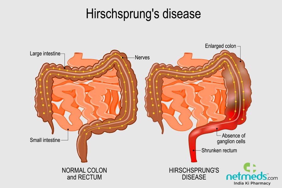 Hirschsprung disease