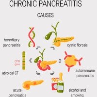 Autoimmune Pancreatitis: Causes, Symptoms And Treatment