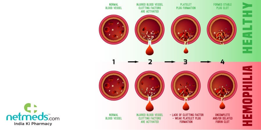 how hemophilia occurs