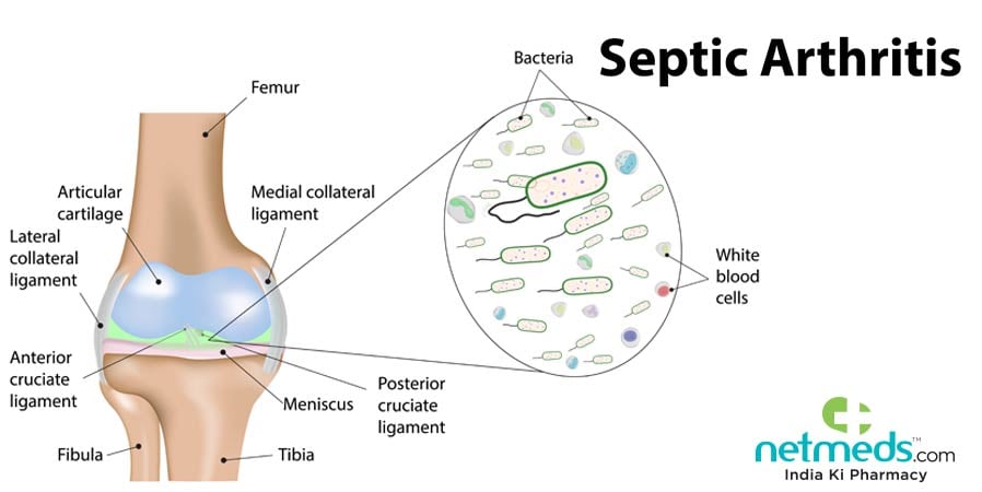 Septic Arthritis Treatment