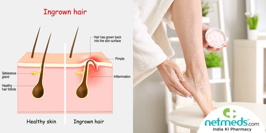 Ingrown hair illustration and a woman touching her feet 