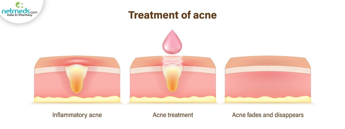 cystic acne causes