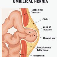 Umbilical Hernia: Causes, Symptoms And Treatment